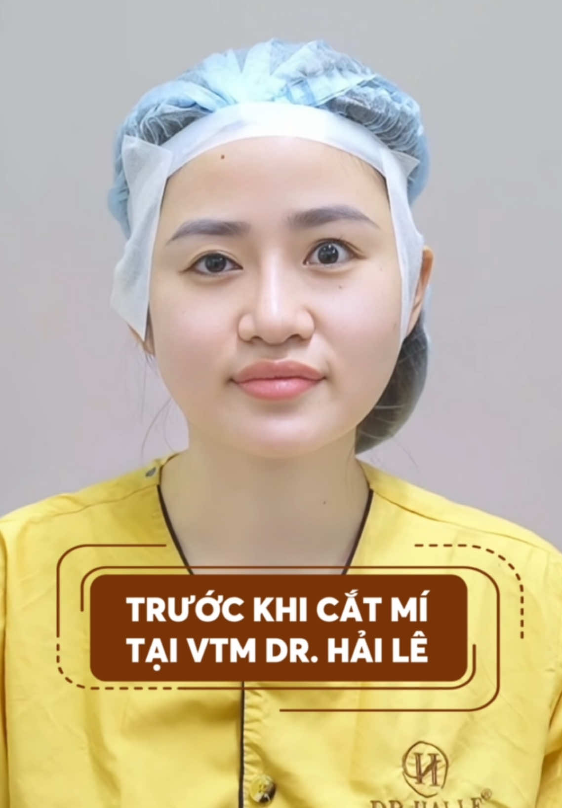 Biến hình với ca mí cường cơ, nhược cơ rất đặc biệt… #vtmdrhaile #thammyhaile #xuhuong #trending #viral #drhaile 