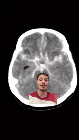 Vem conferir essa dica rápida pra avaliar HSA na tomografia de crânio! 🔍🔍 #tomografia #hemorragia #HSA #hemorragiacerebral #radiologia #deulaudo #medicina #tomografiacomputarizada 