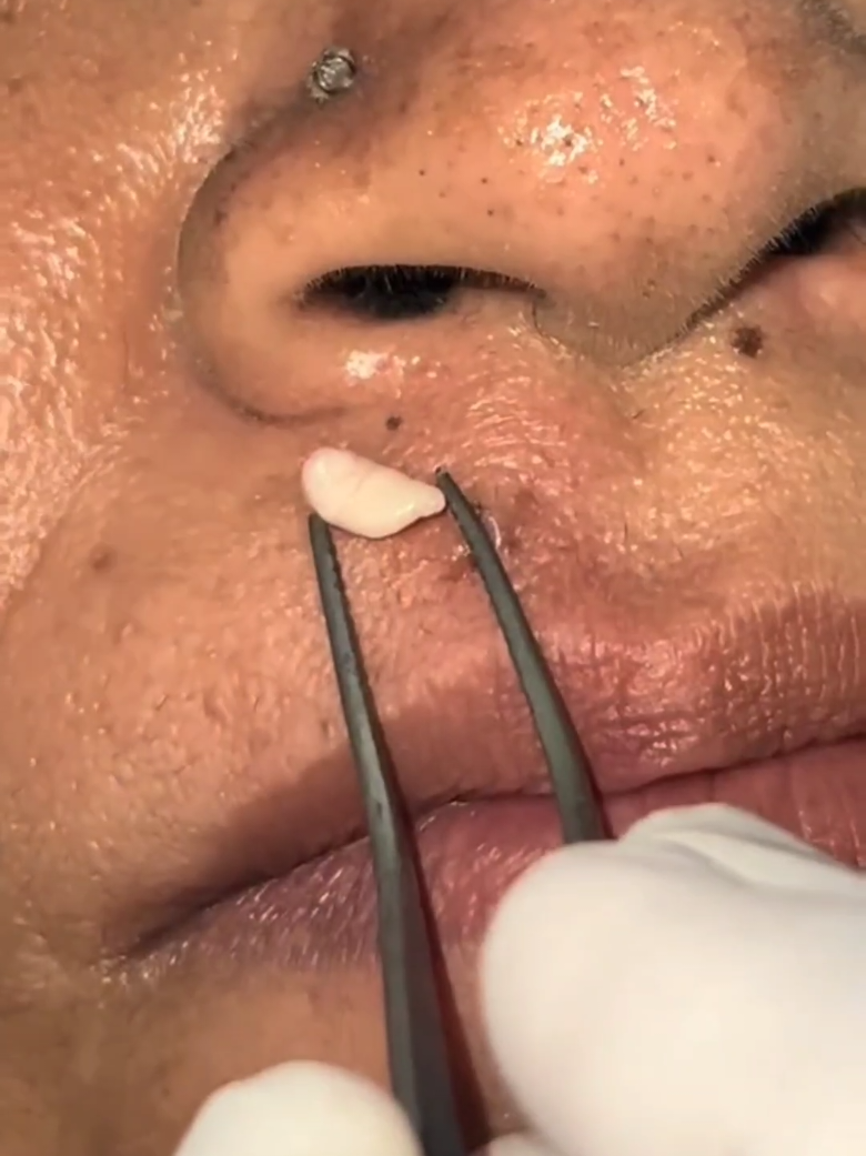 Video satisfatório #GIGANTE #REMOVAL #TIKTOKVIRALVIDEOS #ACNES #CRAVOSEESPINHAS #ESPINHASINFLAMADAS #ESPINHAS #INFLAMAÇÃO #cravoseespinhas #ESPINHAS #CRAVOS #remoçaodecravos #cravosgigantes #remoçaodecravos 