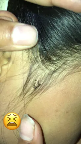 Oh, I didn't expect there to be so many lice bites on my head. It's so itchy#omg#lice#asmr#fyp