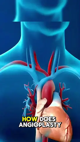 Angioplasty  #Angioplasty #HeartHealth #Cardiology #HeartCare #HeartSurgery #CardiacCare #HeartDisease #CoronaryArteryDisease #HeartAttack #StentPlacement #BalloonAngioplasty #MinimallyInvasiveSurgery #HeartRecovery #HealthyHeart #CardiovascularHealth #InterventionalCardiology #HeartTreatment #HeartWellness #MedicalProcedure #HeartSupport 