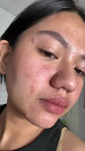 My holy grail serum🫶🏻 #niacinamide #oilyskin #serum #skincare #dermorepubliqserum #dermorepubliq #bigpores #acnemarks #fyp #foryou #foryoupage 