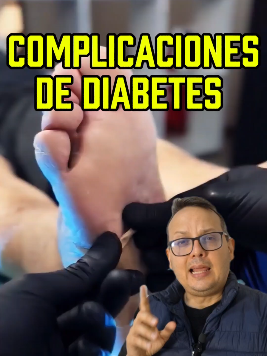 La diabetes no solo afecta los niveles de azúcar en sangre, también puede causar daños graves en la piel y los nervios. Uno de los mayores riesgos es el pie diabético, una complicación que empieza con una simple herida y puede terminar en la amputación de un dedo, un pie o incluso una pierna. ¿Por qué sucede esto? El exceso de radicales libres y el estrés oxidativo afectan la capacidad de cicatrización, lo que hace que las heridas tarden en sanar y se infecten con facilidad. Cuando la circulación se ve afectada, los tejidos no reciben suficiente oxígeno y los daños se vuelven irreversibles. Pero hay formas de reducir este riesgo: mejorando la oxidación celular y controlando el estrés oxidativo con herramientas y suplementos naturales que ayudan a proteger las células y mejorar la cicatrización. También es clave mantener un buen control de la glucosa, una hidratación adecuada y cuidar la piel para evitar heridas que puedan complicarse. Si quieres más información sobre cómo apoyar el control de la diabetes de manera natural y reducir el impacto de los radicales libres en tu cuerpo, visita el enlace en nuestro perfil. Allí encontrarás herramientas y suplementos que pueden hacer la diferencia en tu salud. ¡La prevención es la clave! No esperes a que sea tarde para actuar. #DiabetesCare #BloodSugarControl #OxidativeStress #DiabeticNeuropathy #HealthyHealing #diabetes #diabeticos  #DiabetesSalud #PieDiabetico #ControlGlucosa #SaludNatural #piediabetico 