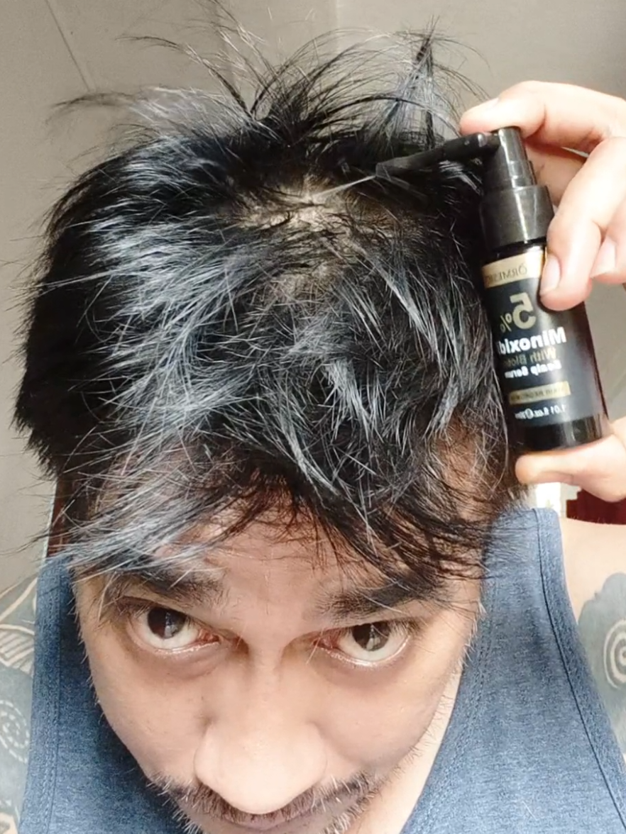 Transform your hair : Minoxidil Experience #minoxidil #hairloss #hairgrowth #baldspot #hairtreatment #kormesicminoxidilwithbiotin #creatorsearchinsights #vibewithron #panot #hair #kalbo #panorth 