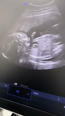 Too many movements my baby love 🥰❤️ Ilang araw palang after ng checkup nag pa-ultrasound ulet ang mommy kase inuubo at sinisipon. And Luckily you’re still healthy my baby love. We can’t wait to see youuuu. 🥹🥰❤️ #5monthsold #pregnancyjourney 