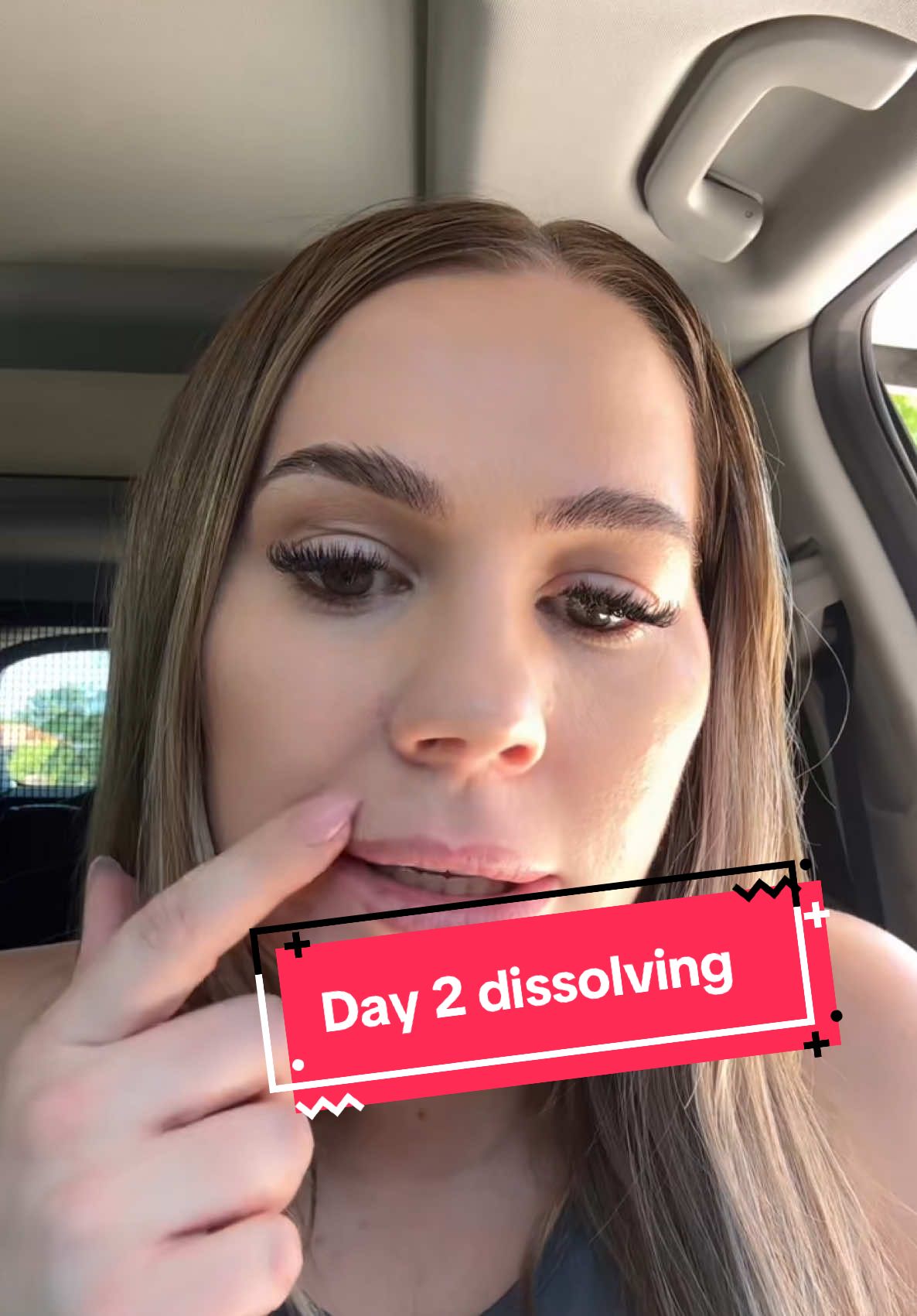 Day 2 #LipDissolvingGoneWrong #SendHelp #ThisWasNotThePlan #dissolvingfiller #dissolvinglips #lipdissolving #lipfiller #cosmetic 