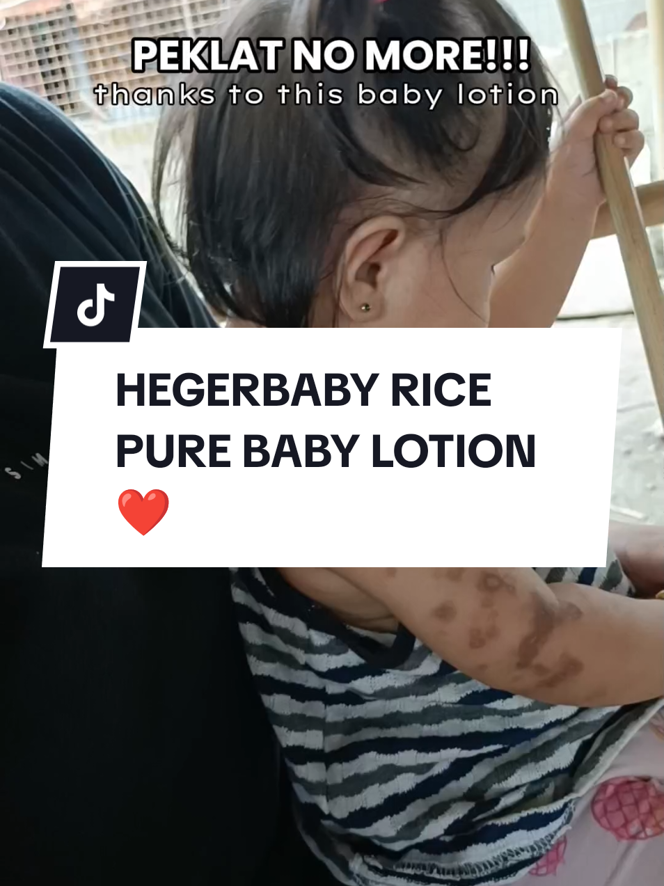 NO MORE PEKLAT NA SI BABY THANKS TO THIS BABY LOTION  #hegerbabylotion #hegerbaby #peklat #eczema #rashes #dryskin #babylotion 