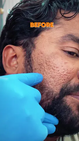 Post acne  scar treatment #team work with Dr KIM  book an appointment at@Celebrita the skin expert  on 03329882053 #foryou #tiktok #CelebritaTheSkinExpert #drwasimmarwatskinbestskinspecilist #peshwar 
