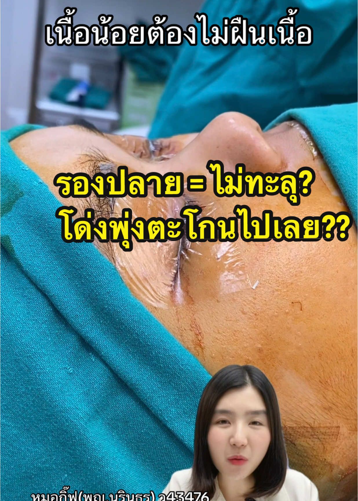 รองปลาย = ไม่ทะลุ? โด่งพุ่งแค่ไหนก็ได้ #หมอกิ๊ฟขอเล่า #หมอกิ๊ฟนรินธร #หมอกิ๊ฟnsc #เสริมจมูกโอเพ่น #เสริมจมูก #โอเพ่นซี่โครง #ดมยาสลบโดยวิสัญญีแพทย์ #lunarribgraft #จมูกโอเพ่น #โอเพ่นปรับโครงสร้าง 