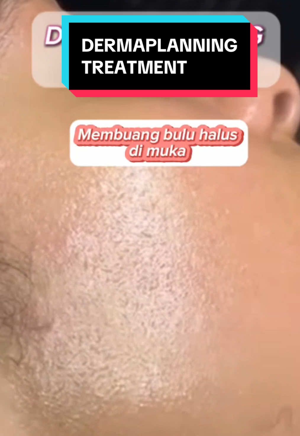 ✨ RAHSIA MEKAP RAYA LEBIH CANTIK & FLAWLESS! ✨ Nak mekap lebih smooth, tahan lama, dan flawless di pagi Raya? Inilah masanya untuk manjakan kulit dengan rawatan Dermaplaning di Sofea Medispa!  #fypp #fyppppppppppppppppppppppp #fypシ゚viral🖤tiktok #skimcareroutine #sofeamedispa #dermaplanningfacial 