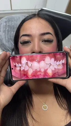 ✨ ¡Increíble transformación con ortodoncia! ✨ Miren este antes y después… ¡No puedo creer la diferencia! 😱🔥 🦷💖 Si estás pensando en ponerte brackets o alineadores, ¡este es tu señal para hacerlo! ✨ ¿Qué les parece el cambio? 🤩 #ortodoncia #brackets #cambioradical #antesydespués #sonrisaperfecta 