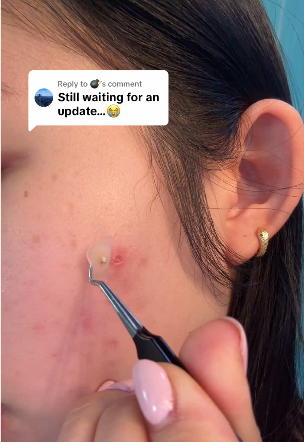 Replying to @💣 #pimple #pimplepatch #pimplepopping #acne 