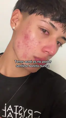 Cuándo será el día que no tenga más acné cuandooooo #paratii #fyp #acne #granos #acnehormonal #triste 