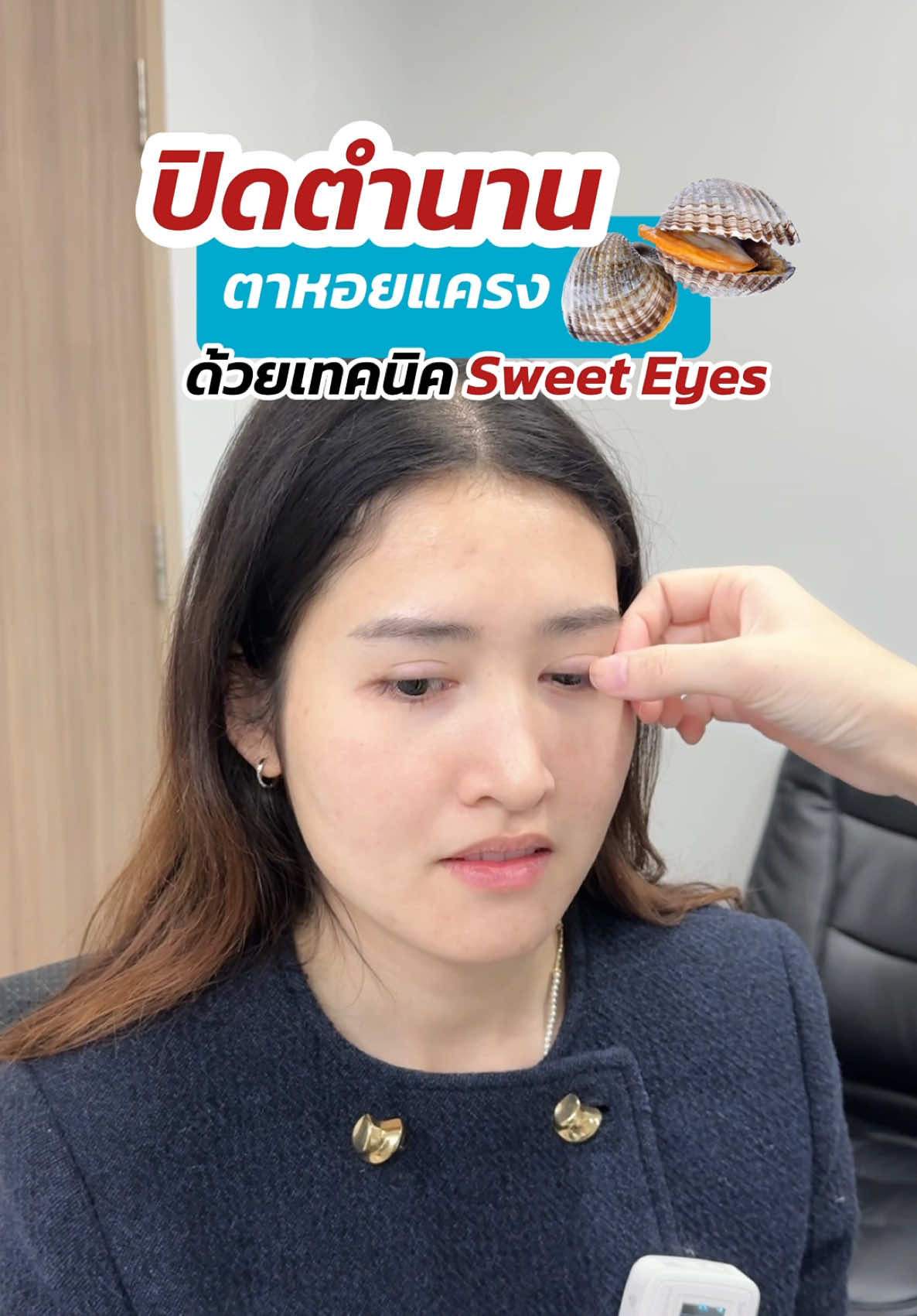 ปิดตำนาน ตาหอยแครง ‼️ กับ #หมอสกาย 🥹 ด้วยเทคนิค #sweeteyes #แก้ตาสองชั้น #เคสแก้ตา #จักษุแพทย์ #skyclinic #สกายคลินิก #ทำตาที่ไหนดี #ชั้นตาใหญ่ #ศัลยกรรมตา #รีวิวตาสองชั้น 