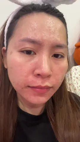Ngày thứ 9 trong hành trình bị Viêm da . Uống thuốc được 5 ngày , bôi dưỡng đều đặn sáng tối , thì da mình đỡ đỏ . Hôm nay tâm trạng cũng khá hơn. Tâm trạng tốt lên để làn da mau phục hồi #viemdacodia #viemdatietba #viêmda #viêmdatiếtbã 