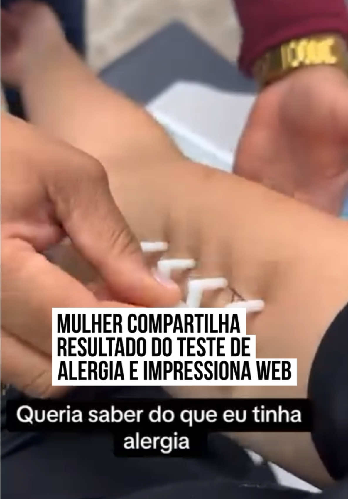 💉 Anna resolveu fazer um #teste para sabe se ela possuía alguma #alergia no corpo. O teste mais conhecido como Prick (ou Teste Cutâneo) identifica substâncias que no corpo pode estar reagindo de forma exagerada, como alimentos, poeira, entre outros. Com esse diagnóstico, há possibilidade de evitar #reaçõesalérgicas e melhorar a #qualidade de vida.  No registro, uma especialista aplica o teste (que aparentemente parece uma presilha de cabelo) no braço de Anna e depois de um tempo é possível perceber o #corpo dela reagindo e mostrando há probabilidade de conter diversas alergias diferentes. Alguns seguidores se identificaram com a situação e comentaram: 