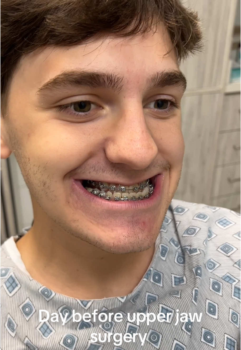 This amazing patient had a large underbite that made it difficult to bite and chew. He also had a narrow upper jaw that caused a cross bite and narrow airway.  This single jaw consisted of a segmental lefort advancement with 7mm widening  So happy for his result and thankful he let me document his recovery!  #jawsurgery #jawsurgeryrecovery #jaw #orthodontist #braces #teeth #smile #jawline #surgery #beforeandafter 