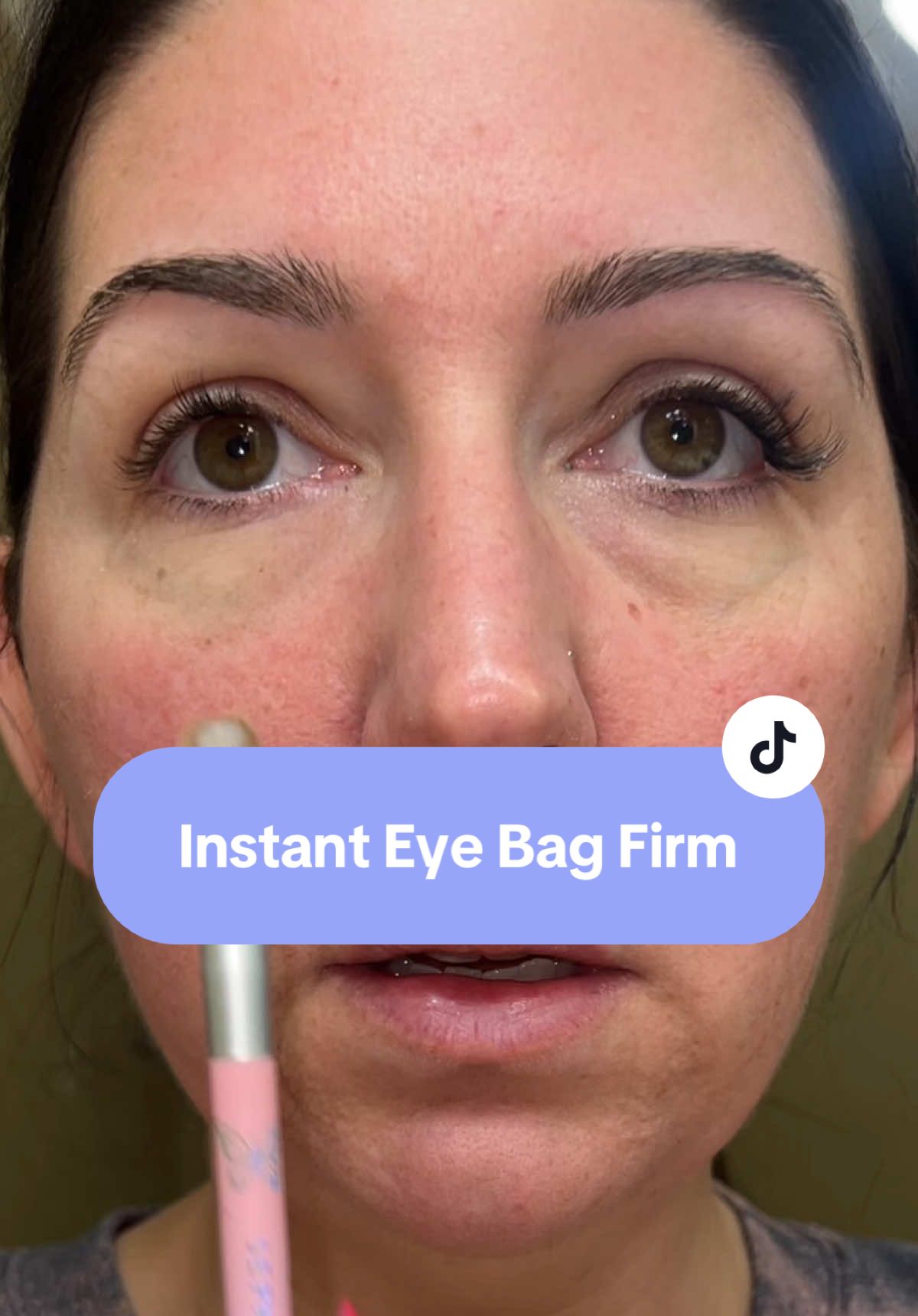 So crazy! #eyebags #eyebag #peterthomasroth #wrinklesbegone #wrinkles 