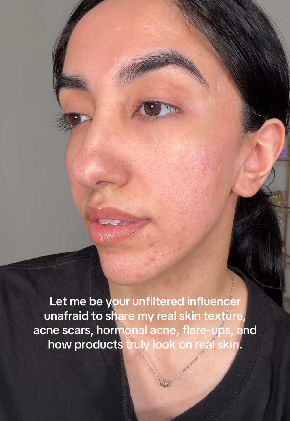 I'll always post unfiltered content showing you how things look on my textured, acne-prone, scarred skin! 👏🏼 #acneskin #pcos #acnescars #unfiltered #influencer  #beautyinfluencer #realskin #fyp #skincare #makeup 