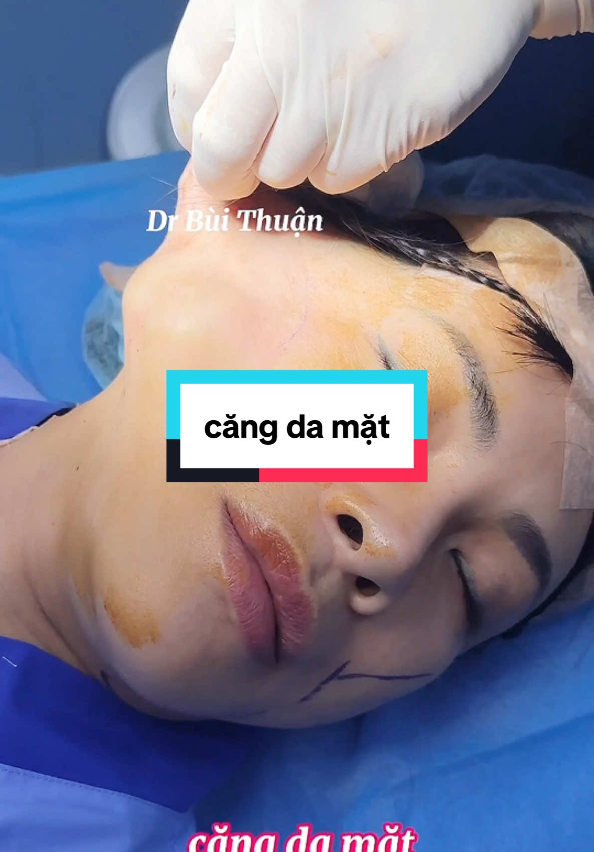 căng da mặt #bsbuithuan #pttm #cangda #cangdamat #cangdamini #cangdathaiduong #cangdatran #cangdaco #trehoa #trehoada#trehoakhuonmat #nangcomat #xoanhan #canchinhkhuonmat #xuhuong #viral #video #facelift #trend #tphcm 