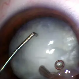 Tackling a soft white cataract! 👁️✨ Watch the precision of phacoemulsification in managing this challenging case. Every move counts for a clear vision! 🔬💉 #WhiteCataract #SoftCataract #CataractSurgery #Phacoemulsification #EyeSurgery #Ophthalmology #Precision  #fyp #viral #trending #trump #AIRevolution #EcoFriendly #MentalHealthMatters #TechTrends #DIYProjects