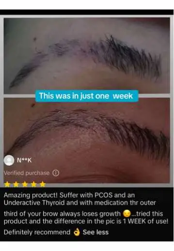 She thought her brows were ruined forever. Years of overplucking had left them sparse, uneven, and struggling to grow back. No matter what she tried—oils, serums, DIY remedies—nothing seemed to make a difference. Every morning, she filled in the gaps with makeup, hoping no one would notice just how thin and patchy they had become. But then, she found our Brow Conditioning Gel. Instead of waiting and hoping for her brows to regrow on their own, she started nourishing them daily. She replaced neglect with care—applying our brow conditioning formula packed with castor oil, argan oil, and grapeseed oil to deeply hydrate, strengthen, and protect her brows. At first, she doubted it would work. The first week, her brows felt softer but looked the same. By the second week, she noticed less fallout and stronger brow hairs. By the fourth week, the transformation was undeniable—her brows were thicker, fuller, and finally growing back evenly. The patchiness faded, the brittleness disappeared, and for the first time in years, she felt confident in her natural brows. Now, she no longer hides behind brow pencils—her real brows are back, and they look better than ever. The secret? Consistent care, deep conditioning, and our Brow Conditioning Gel. ✨ Brow recovery is real. You just have to start. ✨ #BrowTransformation #BrowGrowth #FullBrows #BrowCare #BeforeAndAfter #BeautyHacks #BrowGoals