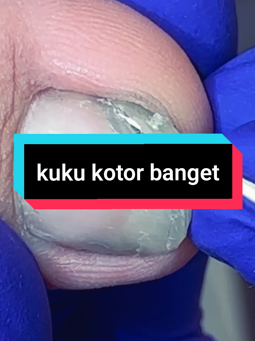 kuku kotor banget gara gara war takjil paling depan padahal nonis... #cantengan #onychomycosis #ingrowntoenailremoval #alatkesehatan #fyp #viral 