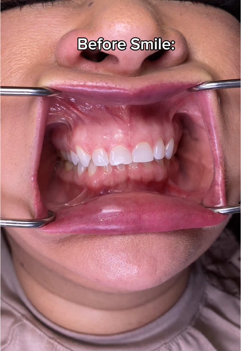 Got a gummy smile? Nothing gum contouring + veneers can't fix! 🤝 #gummysmile #smallteeth #gummysmilecorrection #smallteethtransformation #veneers #dentalveneers #teethtok 