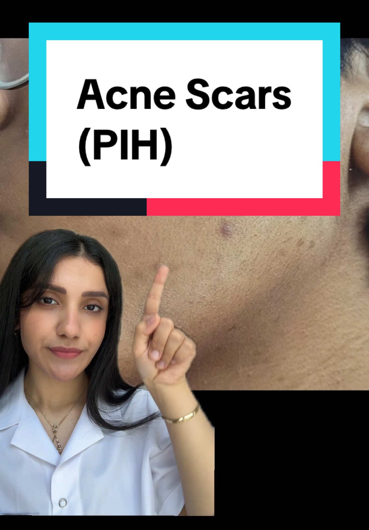 Tone Brightening Capsule Ampoule is a great choice for fading post-inflammatory hyperpigmentation (PIH) and redness from acne scars. With niacinamide, tranexamic acid, and Centella Asiatica, it helps brighten skin, even out tone, and strengthen the skin barrier. However, for deep, pitted scars. Consistent use is key for visible results. #acnescars #acnemarks #darkspots 