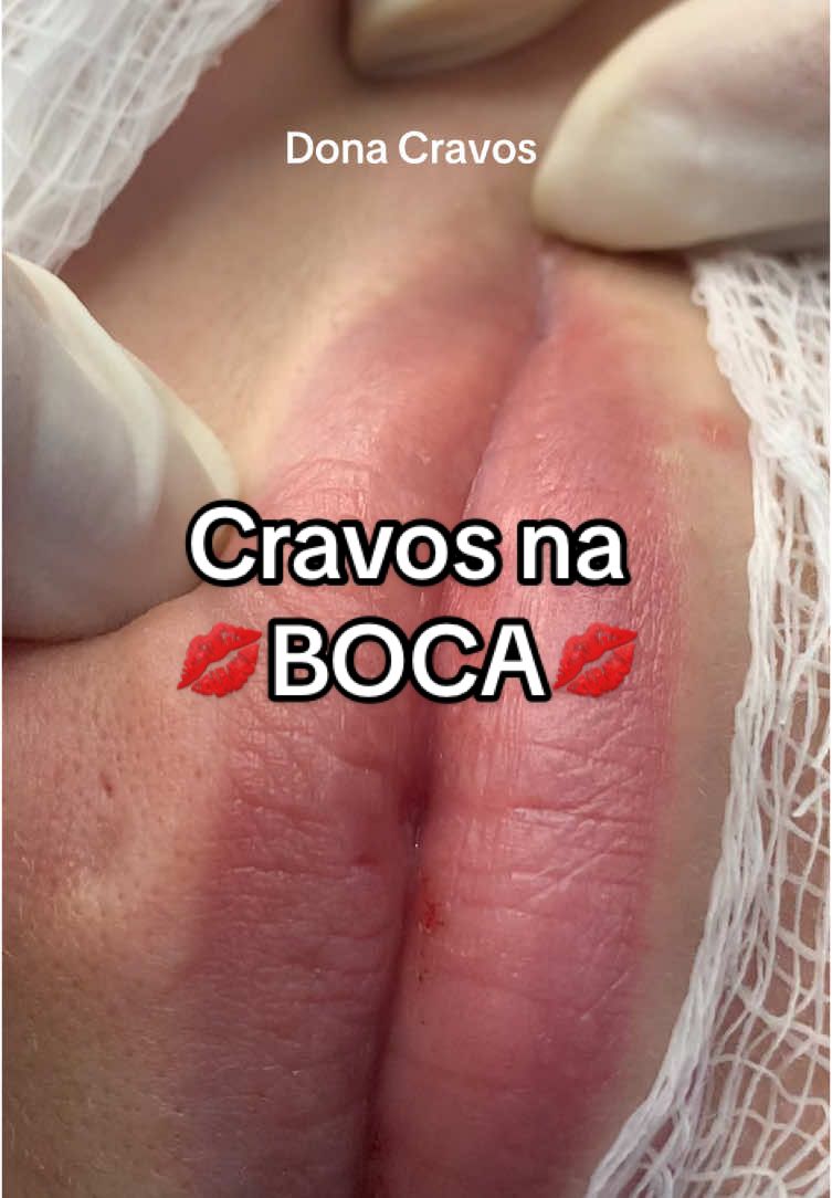 Estavam com saudades? 👀❤️Cheguei chegando com esses cravinhos satisfatórios que estavam bem escondidos na 💋 da minha cliente! Gostaram? 😁😁😁😁 #limpezadepele #donacravos #estranhamentesatisfatório #blackhead #extraçõesdecravos 