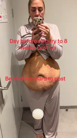 This was hard to post old me to new me. Please be kind. That video was day before surgery till now 8 weeks post op. I have come a long way from sleeve to 360 tummy tuck with lipo and muscle repair. @Nordesthetics #drpajeda #myjourney #positivity #bekind #postop360tummytuck #welsh #lipo #surgery #postoptummytuck #360tummytuck #bigdifference 