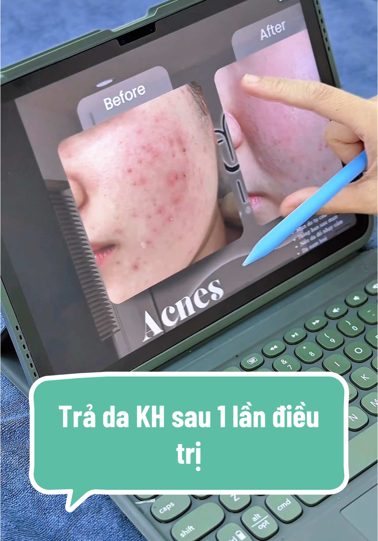 Trả da cho bạn KH , đánh giá đúng tổn thương để điều trị. #munloankhuan #thamsaumun #bsthanhuyen #muntrungca #munvinam #thamsaumun #thamdo #thammun