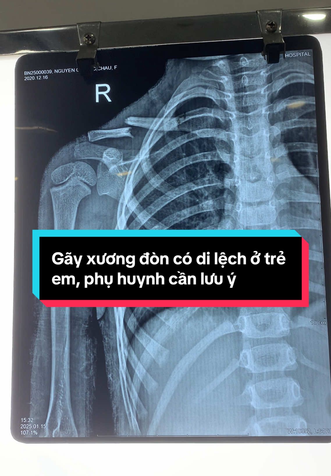Gãy xương đòn ở trẻ 5 tuổi mà bố mẹ không biết do bé không kêu đau, đến khi bé không cho bố mẹ chạm vào vùng tay và vai bên phải thì cho đi khám và kết quả x-quang là gãy xương đòn di lệch, gãy đôi luôn 🫣 phụ huynh hết sức lưu ý đến các con nhé! #xuhuongtiktok #bacsiquynhphcn #gayxuong #gayxuongdon #phcn #vltl #ykhoa #PHCNdaychang 