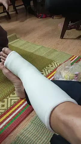 bố mình bị gãy chân 