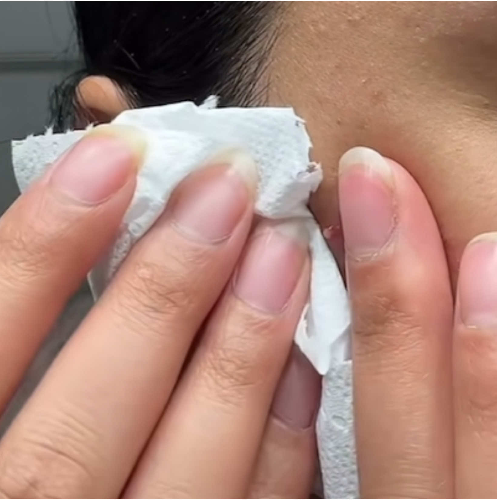#cravoseespinhas #pimpletok #pimplepop #squeezeyuk #satisfatório #satisfaction #espinhas #cystpopping #pimplepatch #skincare 