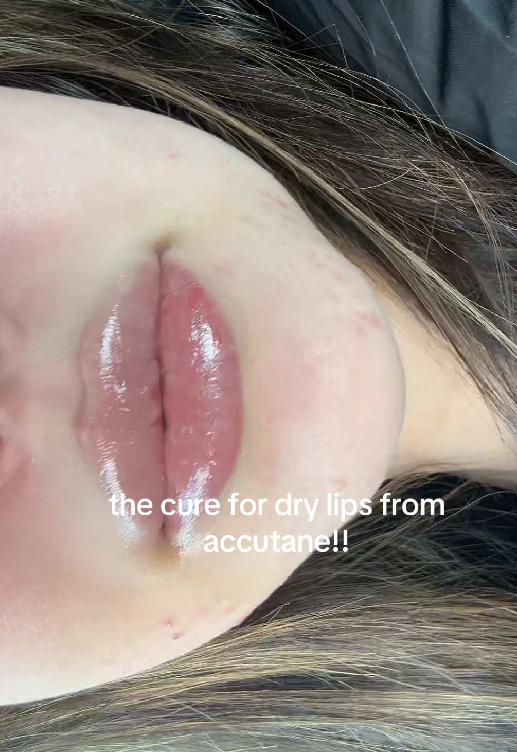this is the only thing that works for my dry lips from accutane, or even how dry it gets in my city!!!  #accutanejourney #accutanelips #drylips #bestlipbalm 