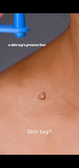 Skin tag removal kit , easy to use and affordable! #skintag #skinremovalsurgery #skintagremoval #skin tag removal device #removal #removalskintag #moleremoval #moleremover 