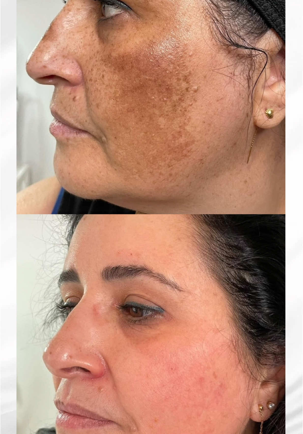 ✨ “I Thought My Pigmentation Was Just Part of Ageing” ✨ This lovely patient came to us feeling defeated, believing her pigmentation was something she just had to live with. She had tried everything and was ready to give up—until she met Erika. Now? When she looks in the mirror, she can’t believe the results. She even calls Erika her magician! ✨  But as a Medical Aesthetics Practitioner, Erika knows it’s not magic—it’s the science and technology behind her protocols that makes all the difference. ✔ Clinically proven to target pigmentation at the source ✔ Medical-grade treatment performed by authorised experts ✔ Safe & effective for all skin tones Seeing her patients regain confidence in their skin is why Erika loves what she does. Ready to start your journey? DM us to book your consultation today! 📞 0208 505 0001 💌 info@luxuriousbeautyboutique.co.uk 📍 253-269 High Road, Woodford Green IG8 9FB #PigmentationRemoval #EvenSkinTone #MedicalGradeSkincare #AestheticClinic #SkinConfidence #LuxurySkincare #SkinRejuvenation 