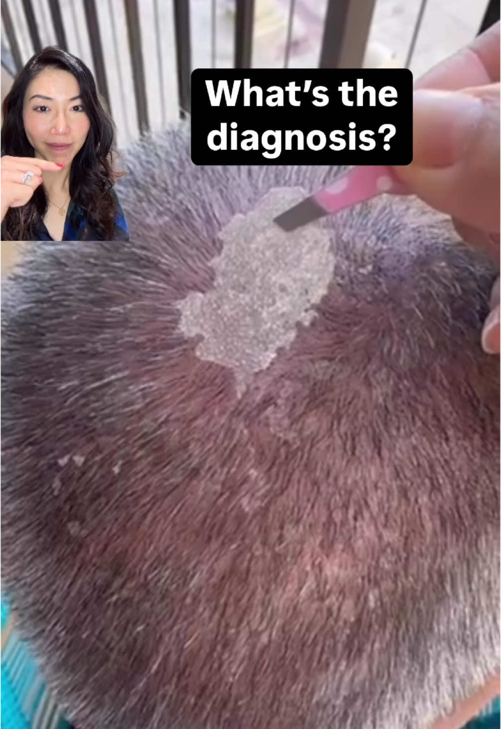 Follow if you want to find out 🫢 Hint: this is actually my dad’s scalp from our recent vacation… Any guesses? 👇  #dermatology #derm #skindisease #skincondition #scalp