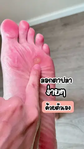 ใครเป็นตาปลาตั้งแต่เด็กแล้วไม่รู้วิธรเอาออก มาลองแผ่นแปะตาปลาตัวนี้เลย #ตาปลา #ตาปลาที่เท้า #พลาสเตอร์ปิดตาปลา #หูด #แผ่นแปะตาปลา #แผ่นแปะหูดตาปลา #CapCut 