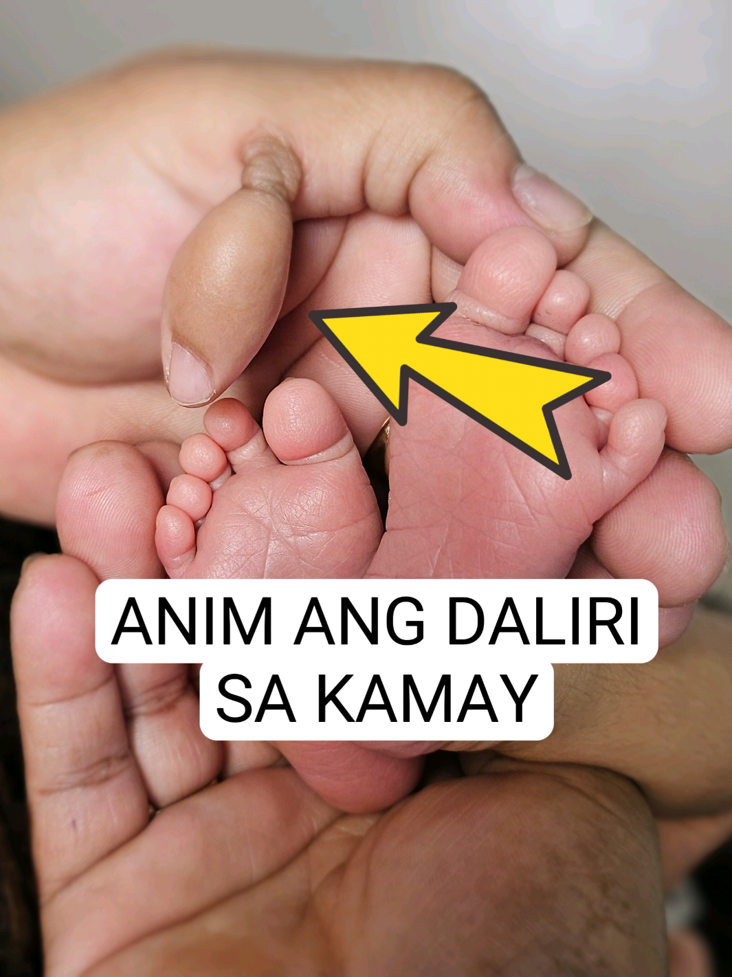 POLYDACTYLY #fyp #foryou #Midwifekarenatyourcervix
