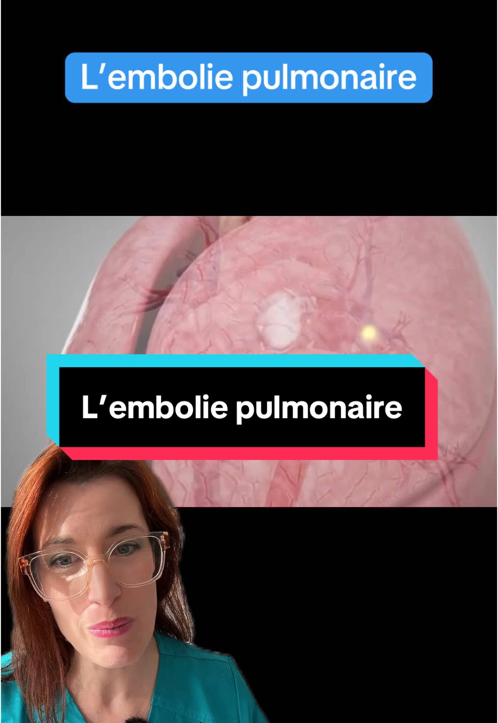 L’embolie pulmonaire est une urgence médicale. Elle cause 15 000 décès par an en France. Ces symptômes sont un essoufflement une douleur thoracique ainsi qu’une sensation de palpitations. Les facteurs de risque sont la pilule œstroprogestative, le tabac, l’immobilisation et la chirurgie récente. #emboliepulmonaire #phlebite #urgence #medecine #apprendresurtiktok #pilule #contraception #tabac #devinelapersonne 