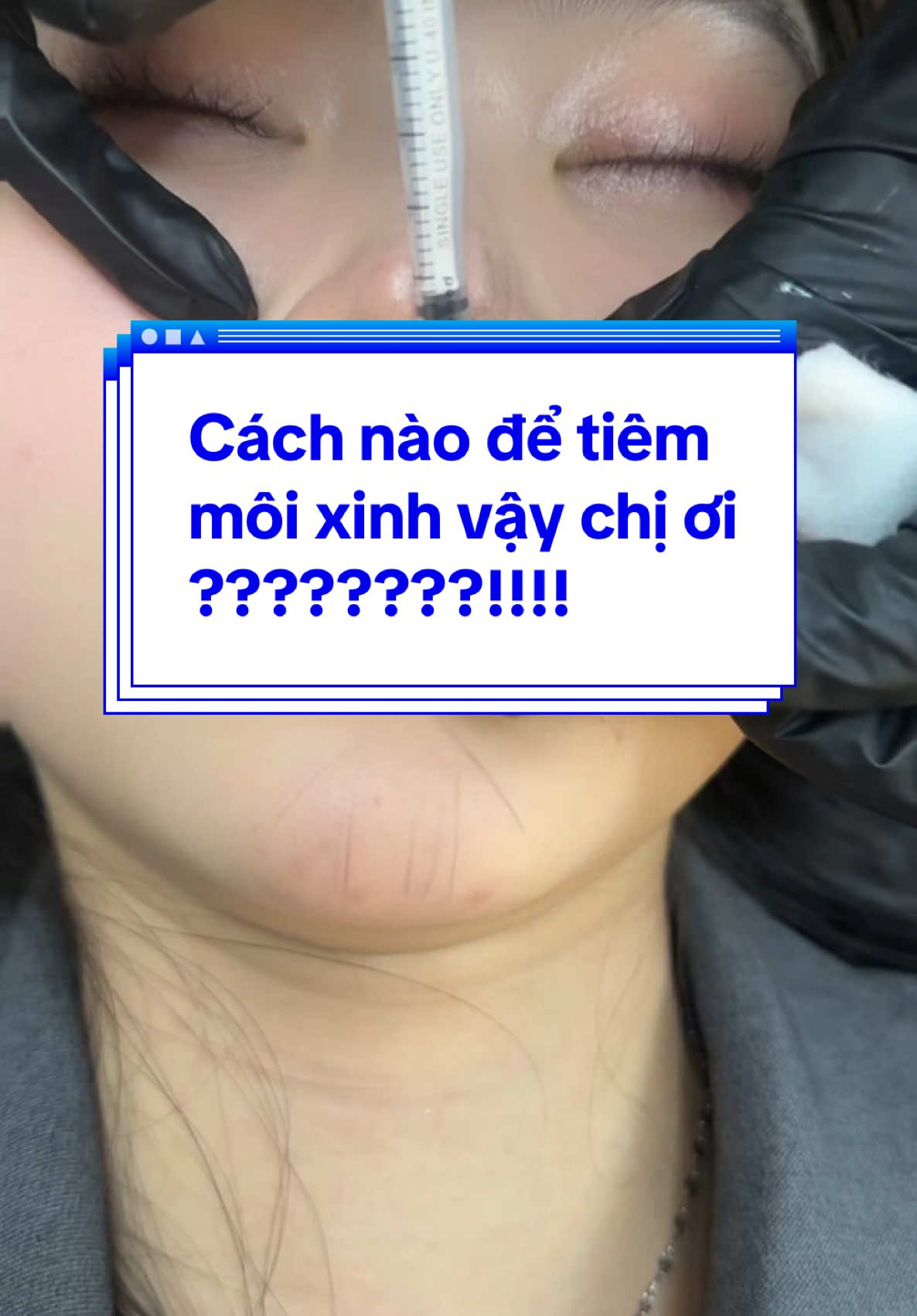 Cách nào để tiêm  môi xinh vậy chị ơi ????????!!!##Nângcơ #CấpẩmHA #thongonham #mỡ_bụng #mdcode #botoxvai #Trắngdacăngbóng #Trẻhoá #TiêmNângCơTrẻHoá #ứcchếmồhôinách #TiêmNângCơTrẻHoá #Profhilo #karisma #ứcchếmồhôinách #karisma #Nângcơ #sensada #mỡbắptay #rejuran #lipro #LRI_SLINE 