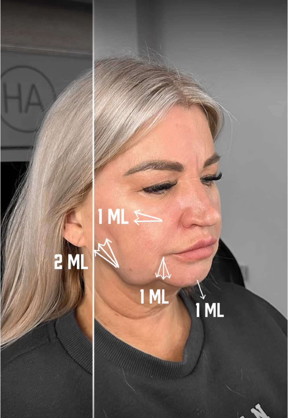 Full Face Transformation: Restoring Balance & Lifting Pre-Jowls 💉 A well-structured face isn’t just about one area—it’s about harmony. Pre-jowls can make the face look aged and uneven, but with strategic filler placement, we can restore youthful contours: ✔ Lifting Pre-Jowls – Adding support to the jawline for a smoother, more defined look. ✔ Midface Volume – Restoring fat pad loss to prevent sagging. ✔ Chin & Jawline Refinement – Creating balance and structure for facial harmony. ✔ Profile Perfection – Enhancing proportions for a naturally sculpted effect. Filler isn’t just about adding volume—it’s about reshaping and restoring! Comment “Facial Profiling” to learn more. #dermalfillers #facialfillers #jawline #jaw #jawfiller #fillers #aesthetics #profilebalancing #facialharmonization 