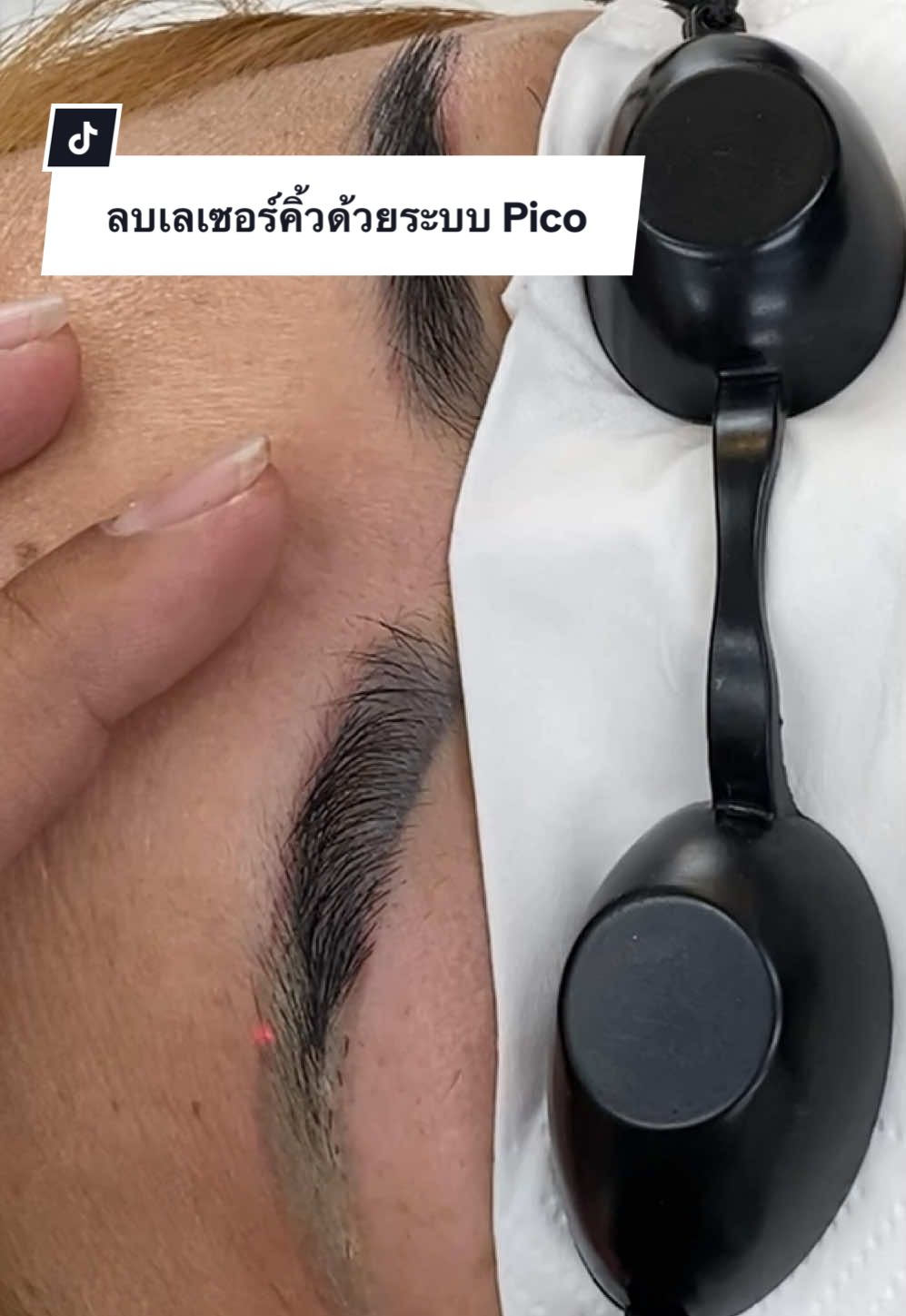 #rabbiteyebrows #ลบเลเซอร์คิ้ว #ลบเลเซอร์กําแพงเพชร 