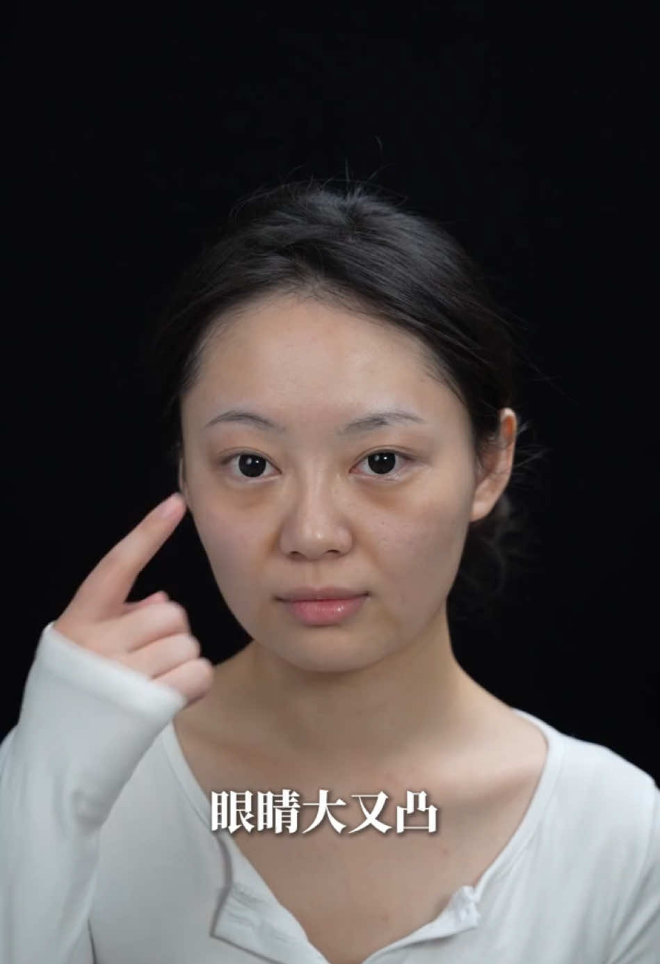 幼态脸打造#beauty#幼态脸 #人中短縮 #上海整形 #facelift #antiaging #beforeandafter 