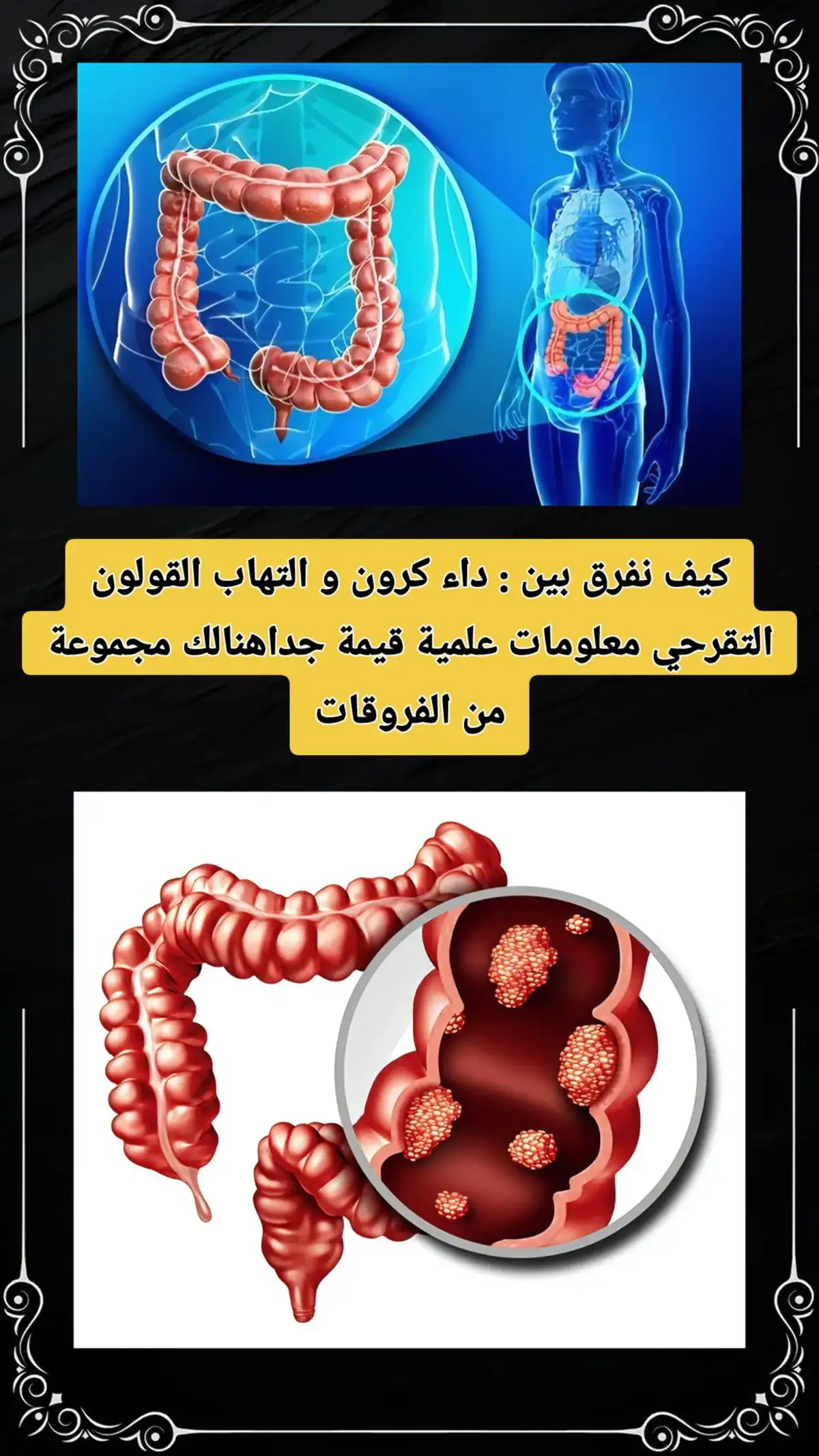 كيف نفرق بين : داء كرون و التهاب القولون التقرحي معلومات علمية قيمة جداهنالك مجموعة من الفروقات #doctorfsl5 #القولون #القولون_العصبي #colon #fyp 