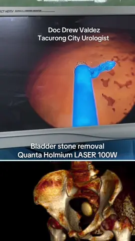 Bladder stone versus LASER. CT scan below.