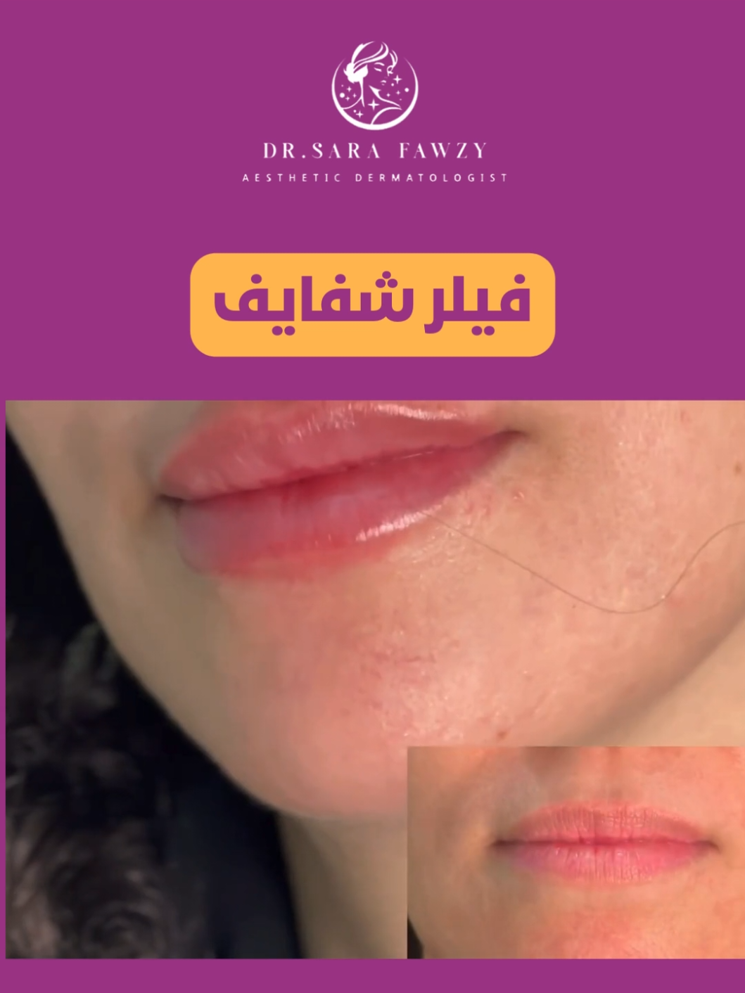 👈 شفاه مثالية ! ✨ فيلر شفايف 👄 بعيادة د. سارة فوزي، حيث التناسق الطبيعي والامتلاء الجذاب. لمسة احترافية تعزز جمالكِ بأسلوب راقٍ ومتقن! 💉💕 احجزي موعدكِ الآن وامنحي شفتيكِ إطلالة ساحرة! 📞  للاستفسارات وحجوزات المواعيد تواصلي معنا: 0506364020 لمتابعة كل حسابات دكتور سارة فوزي : https://linktr.ee/dr.sarafawzy #دكتورة_سارة_فوزي #جلدية #ليزر #تجميل #بلازما #فيلر #بوتكس #نضارة_البشرة #جلسة_الفراكشنال #نضارة_البشرة #بلازما_البشرة #الخبر_الدمام #الدمام #المنطقة_الشرقية #فيلر_شفايف #تساقط_الشعر 