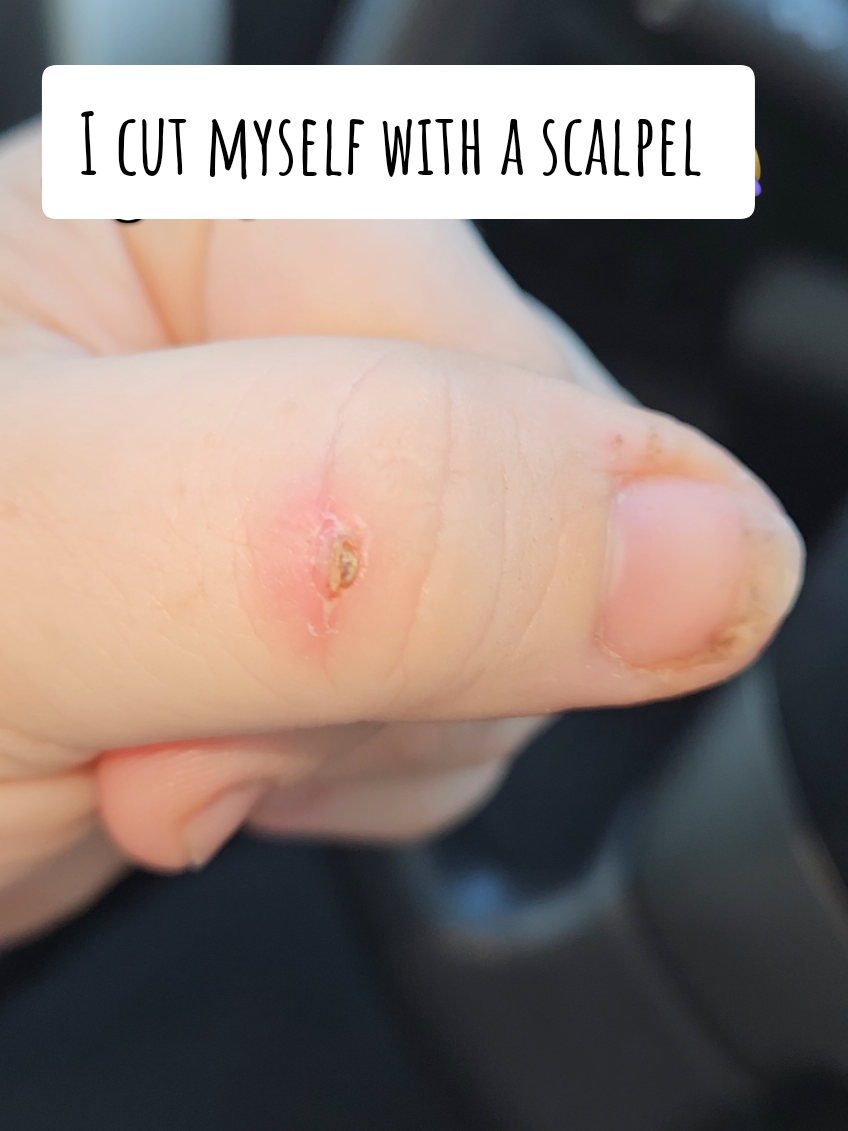 I was really skeptical from all the stories I've heard. I thought there was no way this was that good but I do think it really helped this heal. I think had I of not used this it would have healed over that weird bump 😅 #prid #drawingsalve #realreview @Hyland's 